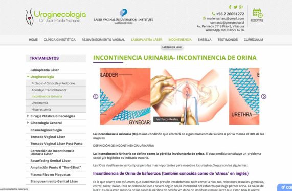 Histerectomía en Chile