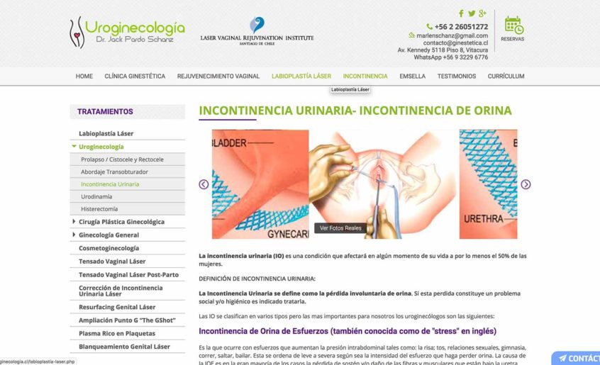 Histerectomía en Chile